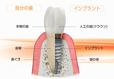 インプラント